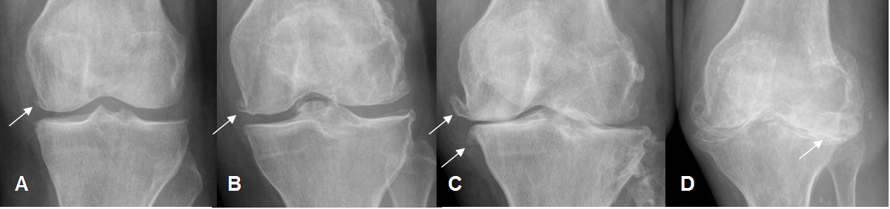 Коленный сустав по стадиям. Гонартроз 2 степени коленного сустава рентген. Деформирующий артроз коленного сустава рентген. Артроз коленного сустава 1 степени рентген. Деформирующий артроз коленного сустава рентгенограмма.