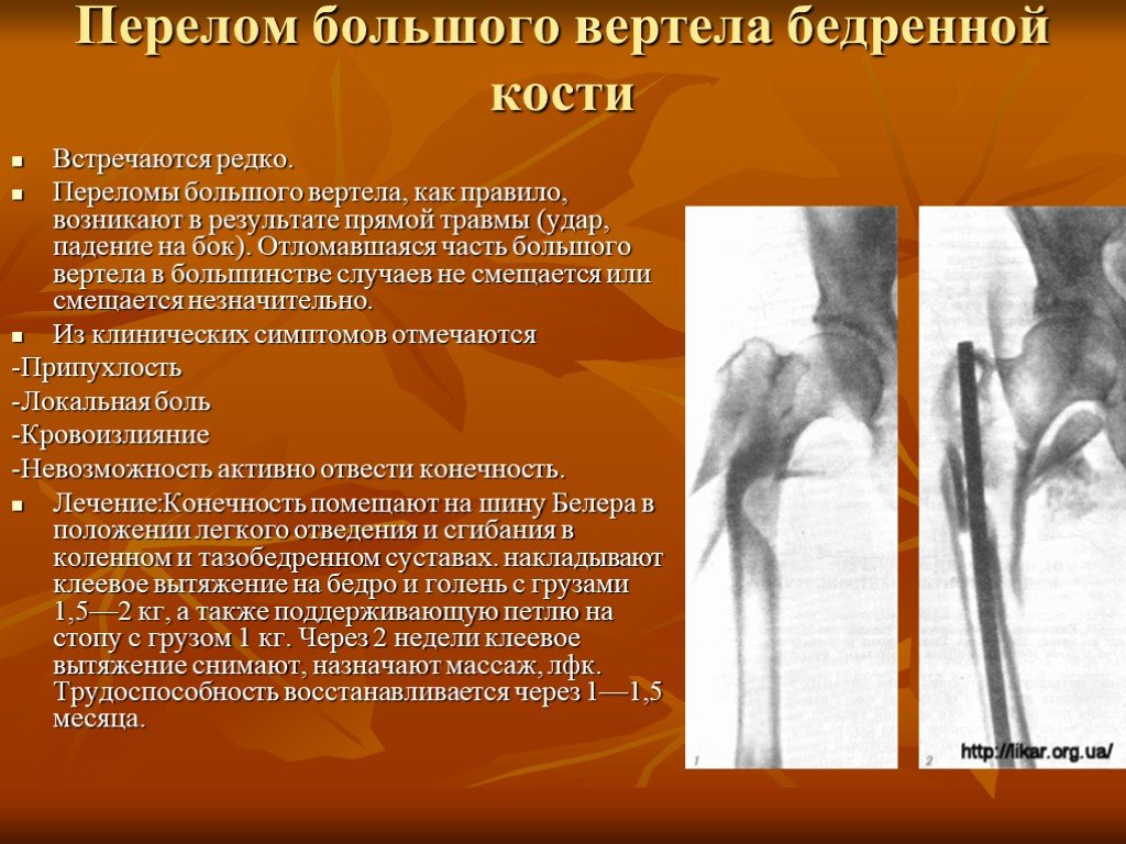 Мкб перелом бедренной. Краевой перелом большого вертела бедренной кости рентген. Краевой перелом большого вертела бедренной кости. Перелом верхнего вертела бедренной кости. Перелом большого вертела бедра.