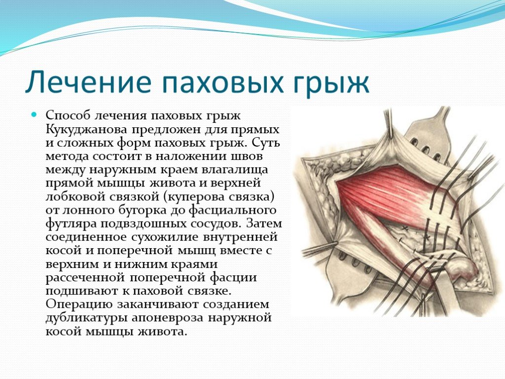 Удаление паховой грыжи у мужчин. Пластика паховой грыжи по Кукуджанову. Операция при прямой пазовой говже.