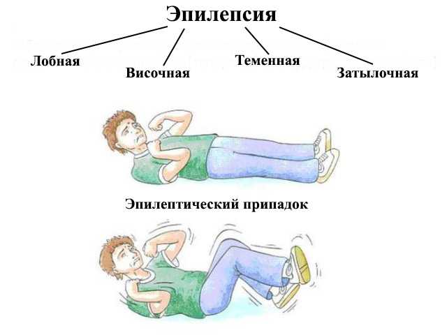Приступ эпилепсии картинка