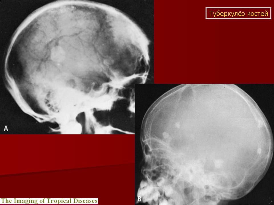 Остеома черепа рентген фото