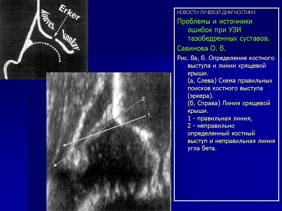 Узи тазобедренного сустава. УЗИ анатомия тазобедренного сустава. Дисплазия тазобедренных суставов УЗИ.