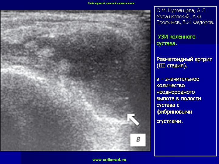 Узи коленного сустава. Ревматоидный артрит УЗИ. Ревматоидный артрит УЗИ суставов. Ревматоидный артрит УЗИ протокол. Синовит коленного сустава на УЗИ протокол.