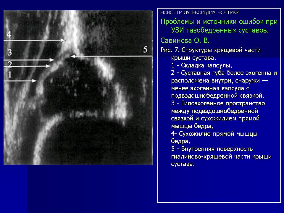 Что покажет узи тазобедренного сустава