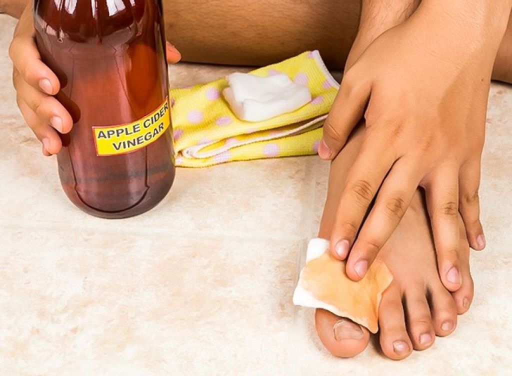 Убрать запах ног в домашних условиях быстро. Народное средство от грибка на ногах. Уксус от потливости ног.