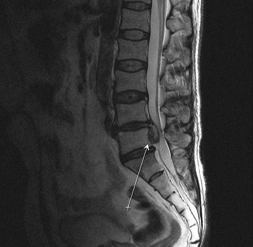Как на мрт выглядит грыжа позвоночника фото