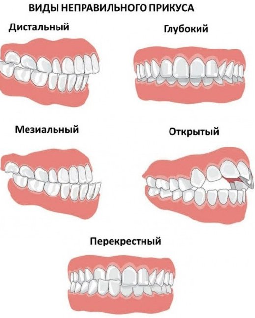 Правильный прикус зубов у человека фото