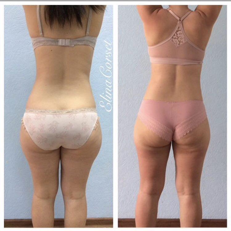Фото до и после lpg массажа тела