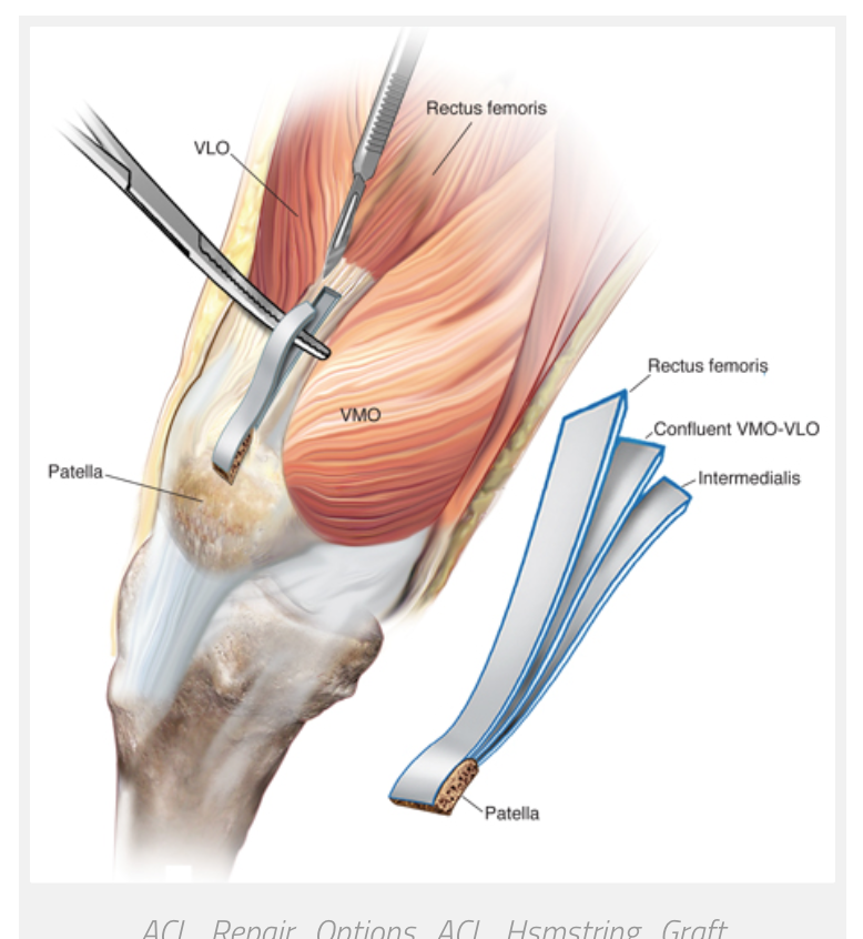 Травмы мышц и сухожилий. Hamstring tendon трансплантат. Бурсит сухожилия подколенной мышцы. Тендинит хамстринг сухожилий.