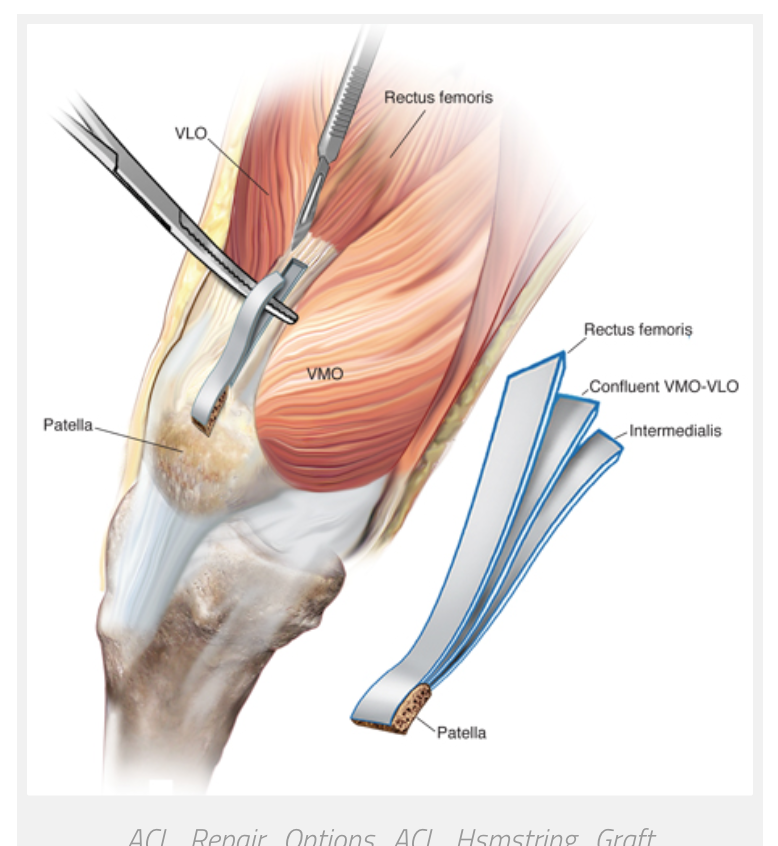 Лечение частичного разрыва мышц. Hamstring tendon трансплантат. Бурсит сухожилия подколенной мышцы. Тендинит хамстринг сухожилий.