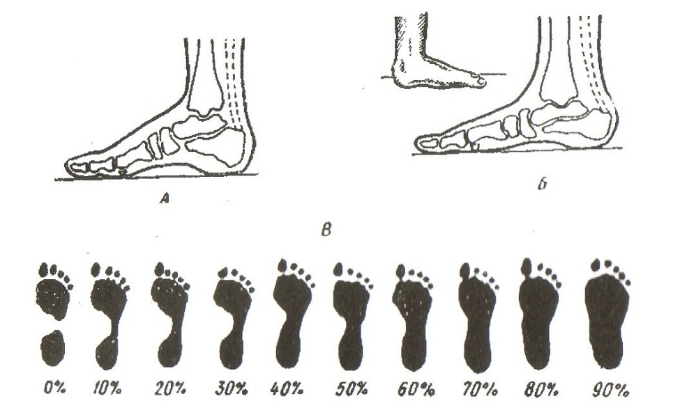Плоскостопие по степеням фото