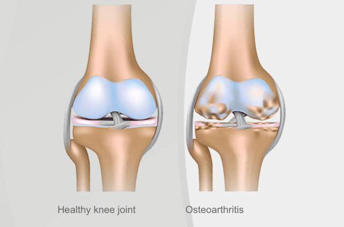 Гонартроз коленного сустава фото лечение