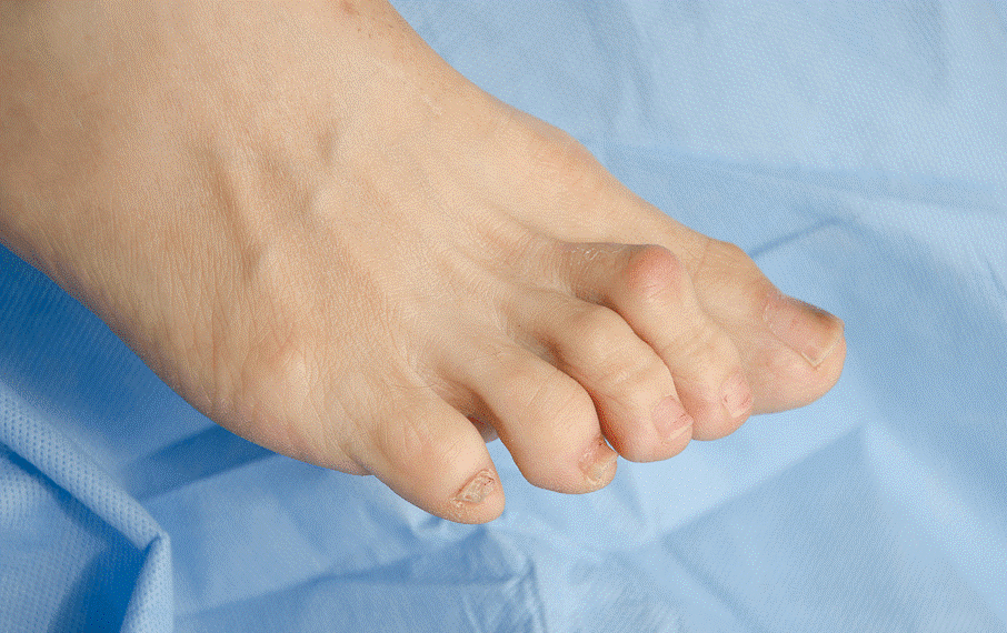 Деформация пальцев стопы мкб. Молоткообразная деформация пальцев ног. Молоткообразная деформация вальгус. Ревматоидный артрит молоткообразная деформация. Молоткообразные пальцы деформации.