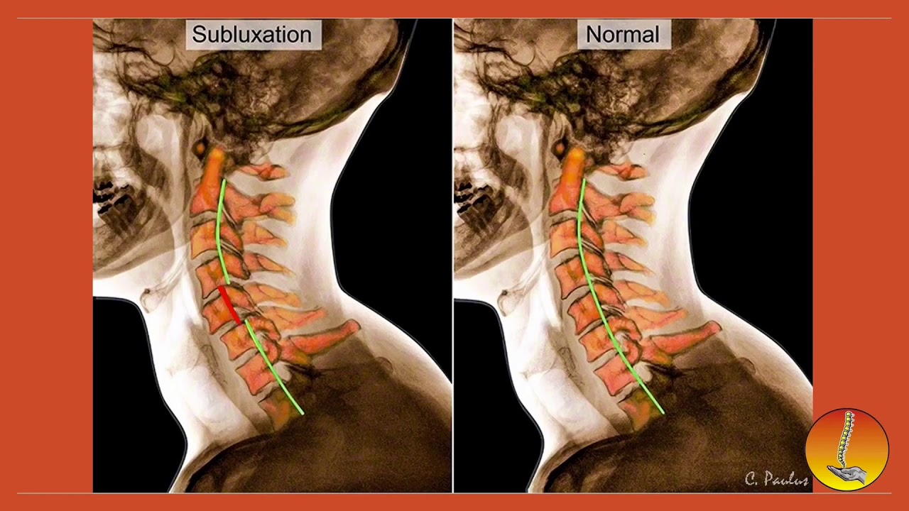 Спинальная нестабильность что это. Смещение шейных позвонков с3 с5. Травма спинного мозга с6 с7 операция. Спинальный ШОК th6. Травма шейного отдела спинного мозга.