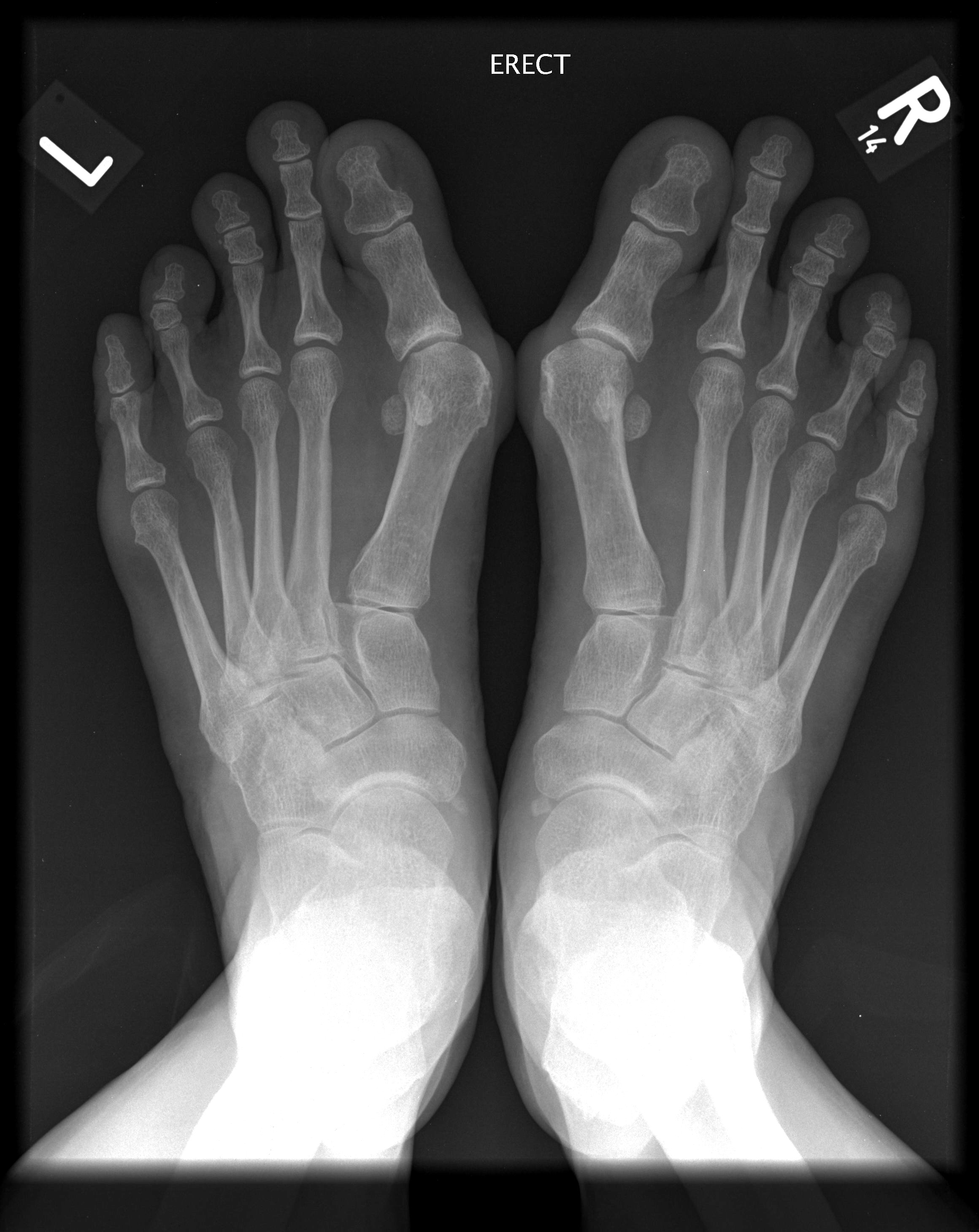 Деформация пальцев стопы мкб. Ревматоидный артрит стопы рентген. Вальгус рентген стопы человека.