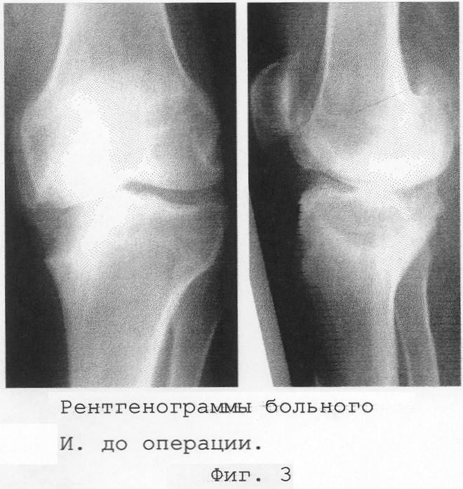 Асептический некроз мыщелков. Асептический некроз коленного сустава. Асептический некроз коленного кости. Асептический некроз медиального мыщелка. Асептический некроз коленного сустава рентген.