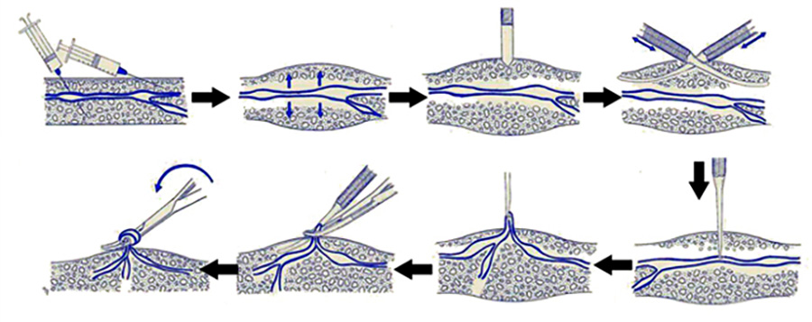 Склероскопия. Операция Мюллера минифлебэктомия. Минифлебэктомия склеротерапия. Флебэктомия по Мюллеру-Варади.