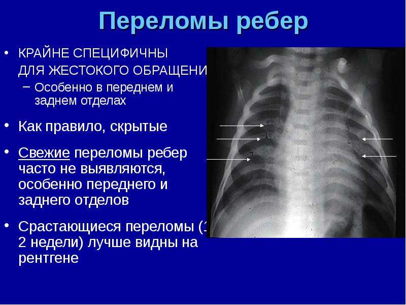 Перелом ребра карта вызова скорой