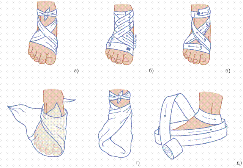 Эластичное бинтование ноги. Схема бинтования голеностопа эластичным бинтом. Забинтовать стопу эластичным бинтом при растяжении. Перевязка голеностопа эластичным бинтом. Наложение повязки на голеностопный сустав Косыночная повязка.