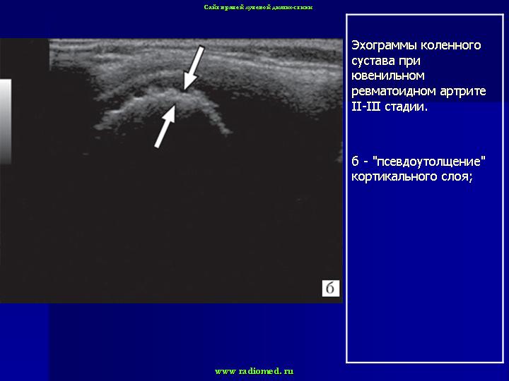 Узи костей детям. Ревматоидный артрит на УЗИ коленного сустава. Остеоартроз коленного сустава УЗИ протокол. Ювенильный ревматоидный артрит УЗИ.