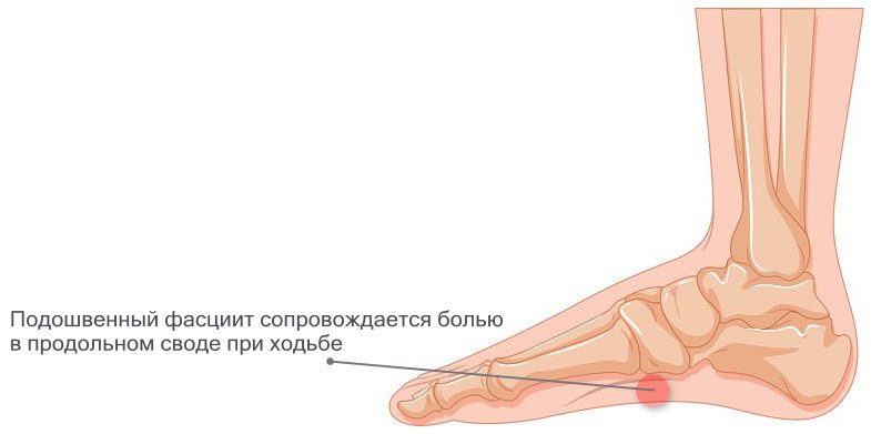 Ступня опухла и болит при ходьбе: Опухла стопа — что это может быть ...