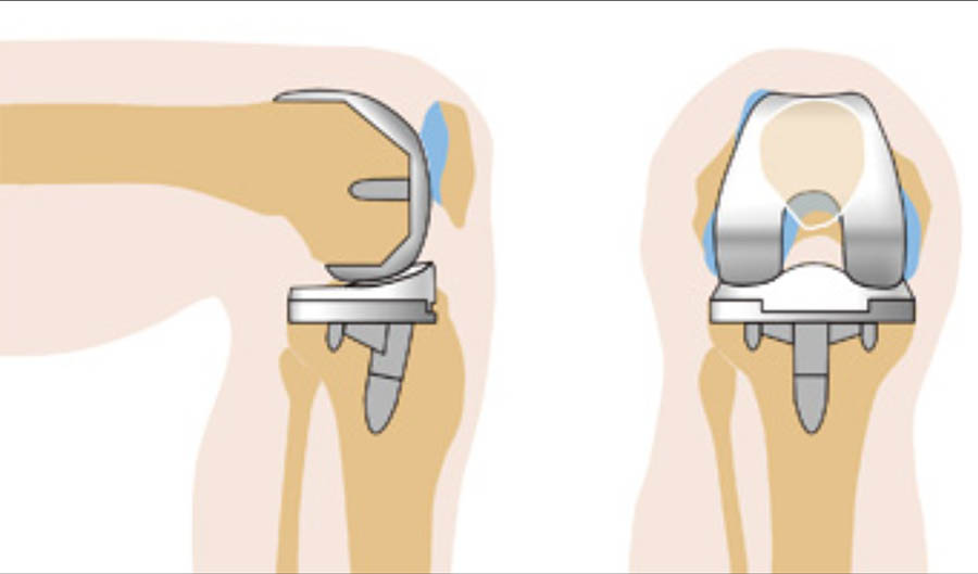Операция эндопротезирование коленного сустава реабилитация. Модульный эндопротез коленного сустава цито. Заднестабилизированный эндопротез коленного сустава. Тотальное эндопротезирование коленного сустава. Рентген эндопротеза коленного сустава после эндопротезирования.